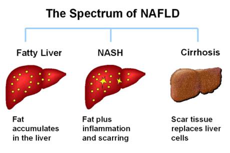 http://trialx.com/curetalk/wp-content/blogs.dir/7/files/2011/05/diseases/Nafld-1.gif