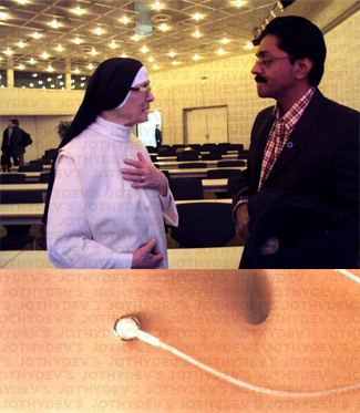 80 yr old nun sister from Germany with Intraperitoneal pump with Jothydev Kesavadev