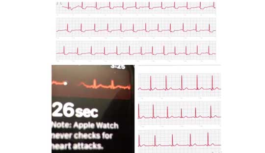 An Apple Watch ECG saves a life,