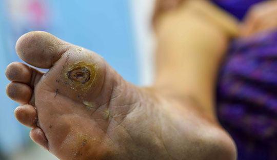 Association of Diabetic Foot Ulcers and Occupational shoes among industrial workers