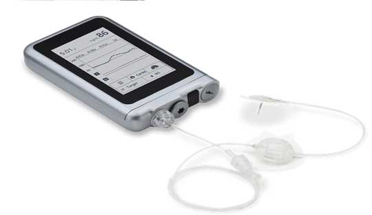 iLet shows promising results as the closest Artificial Pancreas