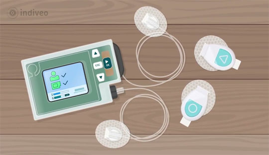 The Rise of the Fully Closed-Loop Inreda AP System management 