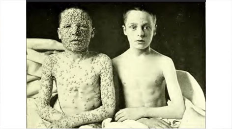 smallpox_comparison