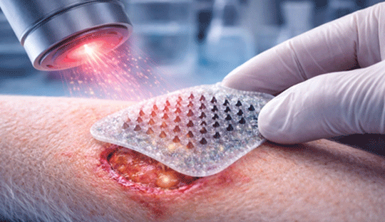 Light-Activated Microneedle Patch Shows Promise for Healing Chronic Diabetic Wounds