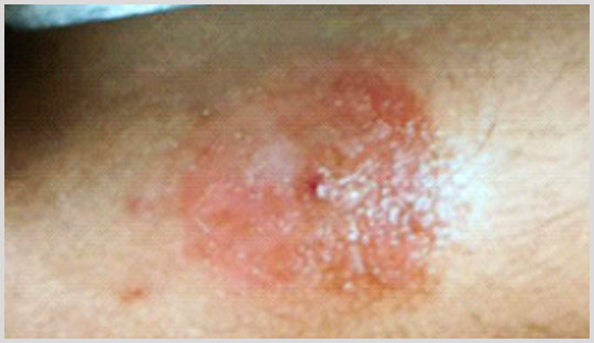 Rare Occurrence of Contact Dermatitis in Children and Adults with Glucose Sensors