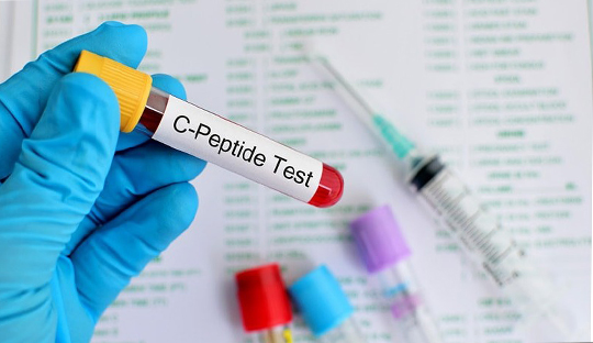 Significance of C-peptide test in diabetes