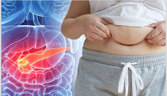 Diabetes with associated weight loss and risk for developing pancreatic cancer